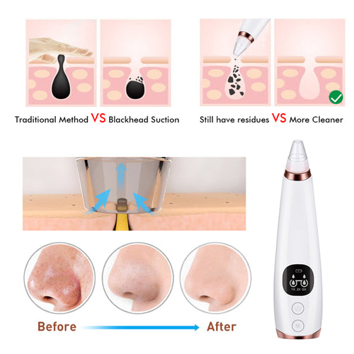 Aspirateur Facial Anti-Points Noirs — Nettoyage en Profondeur 5-en-1